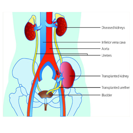 kidney gupta trivedi
